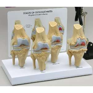   Joint Osteoarthritis 4 stage Anatomical Model